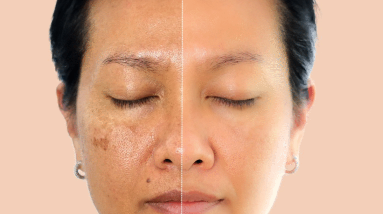 melasma-foto-blog-da-maquiagem