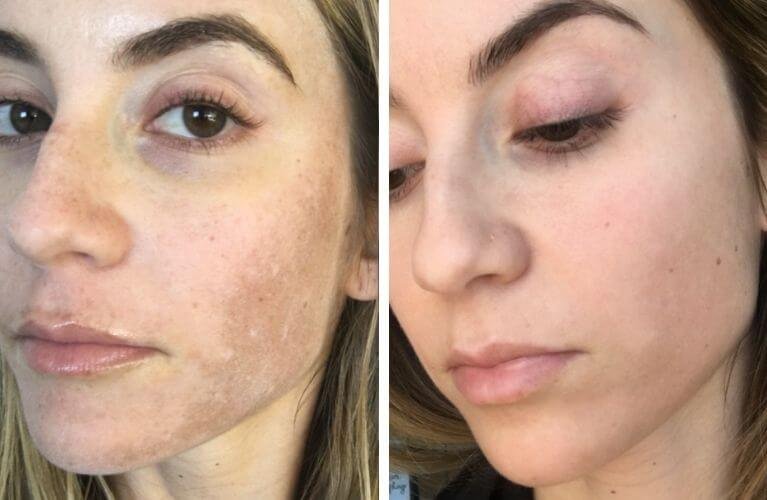 micoragulhamento-para-melasma